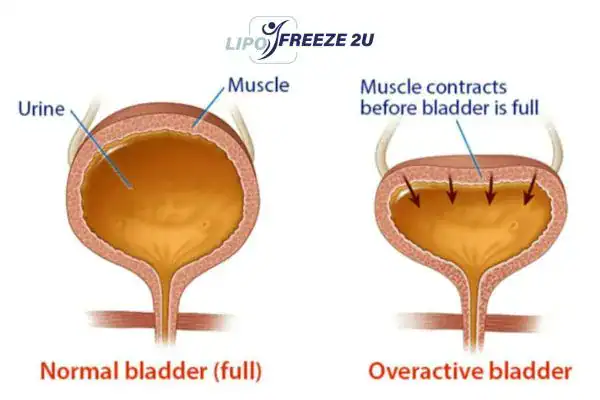 diagram of overactive bladder treatment Lancashire