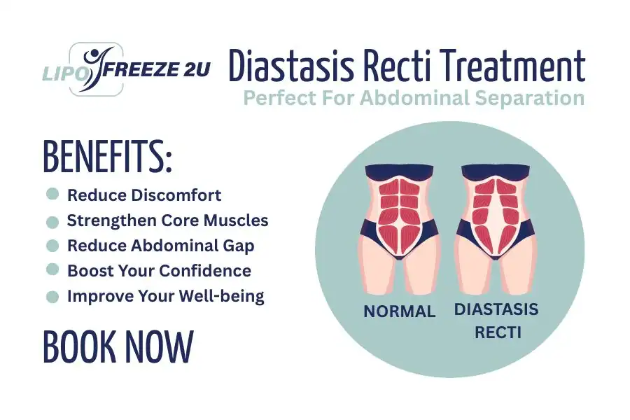 Benefits of body toning treatment Lancashire for Diastasis recti