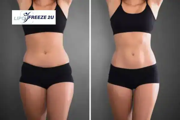 How Can LIPO FREEZE 2U Support Your Post-Pregnancy Body Recovery Lancashire?