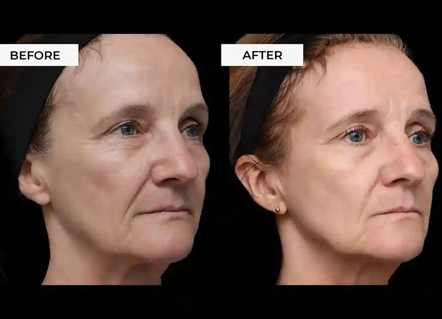 How Many RF Microneedling Sessions Will You Need to See a Difference Lancashire?