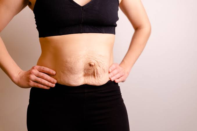 Is Surgery Really the Only Way to Repair Diastasis Recti Lancashire?