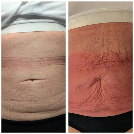 How Does RF Microneedling Improve Crepey, Thin and Uneven Skin Texture Lancashire?