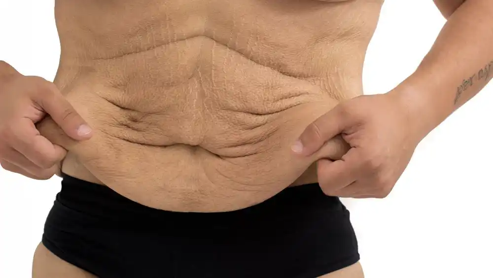 Why Does Weight Loss Medication Leave Some People With Loose or Sagging Skin Lancashire?